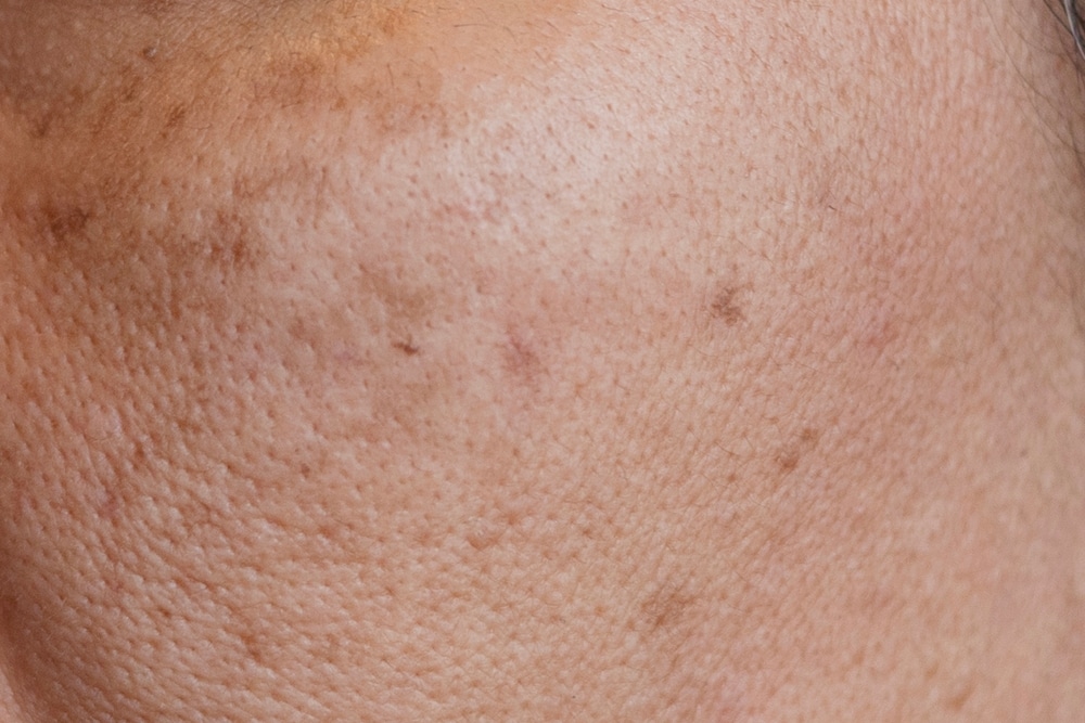 Pigmentvlekken verminderen